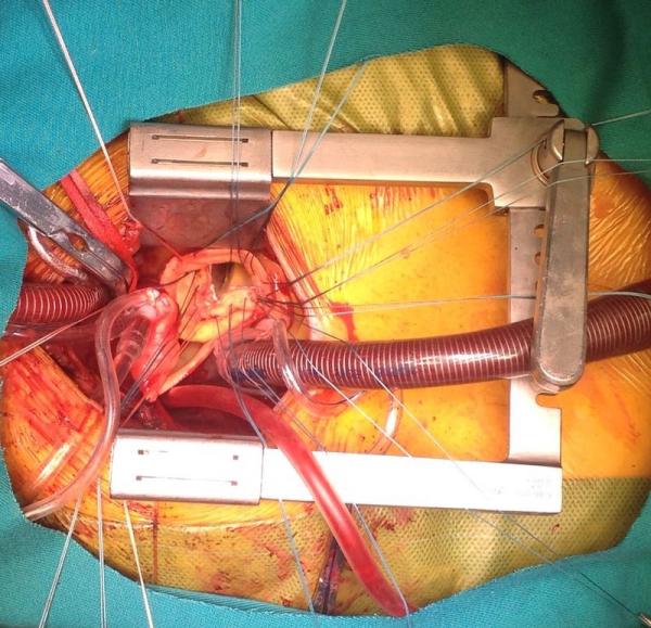 Cirugía de la Aorta, y Endovascular