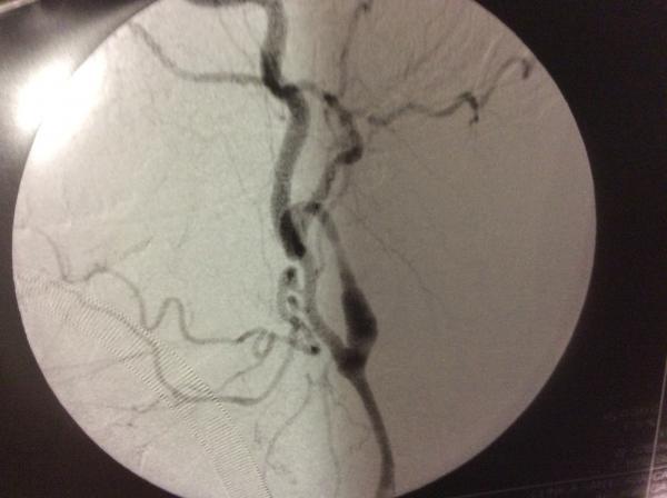 Cirugía Carótidas y Endovascular