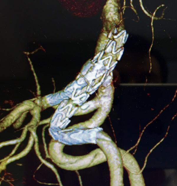 Cirugía Vascular periférica y Endovascular