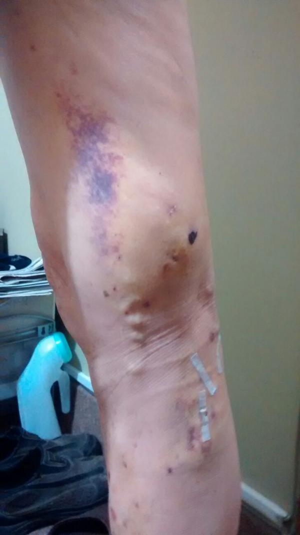 Várices de Piernas, con y sin Laser