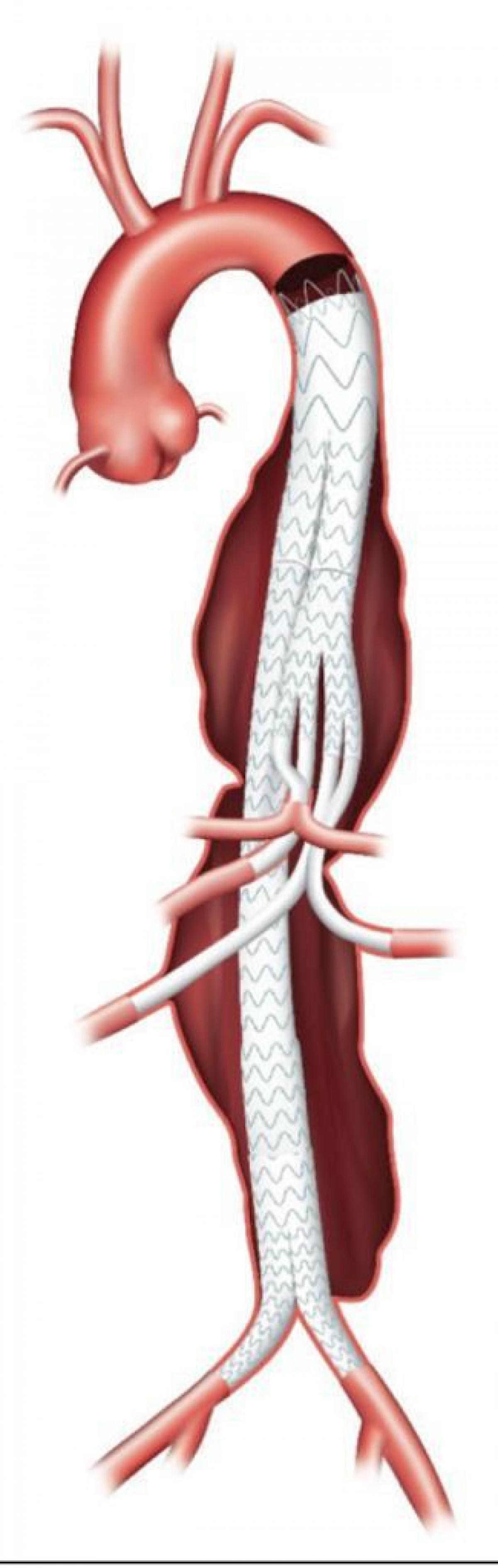 Cirugía de Vasos Vicerales y Endovascular