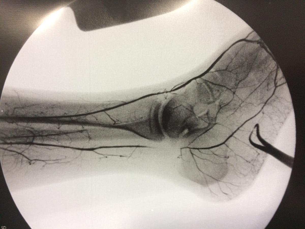 Cirugía Vascular periférica y Endovascular