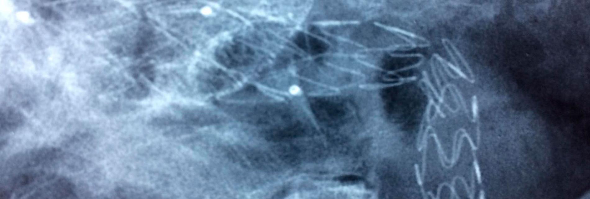 Tratamientos Actuales